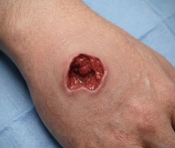 Wound Image