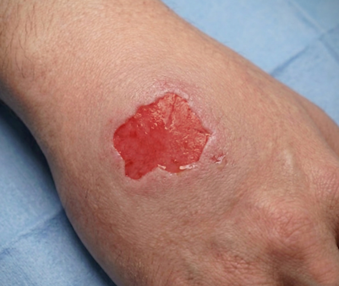 Wound assessment - superficial